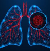 Human,Lung,Cancer,Under,A,Magnifying,Glass.,Polygonal,Design,Of