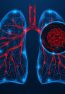 Human,Lung,Cancer,Under,A,Magnifying,Glass.,Polygonal,Design,Of