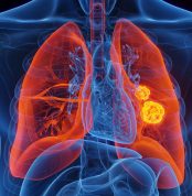 3d,Rendered,Medical,Illustration,Of,Male,Anatomy,-,Lung,Cancer.