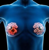 3d,Rendered,Medical,Illustration,Female,Anatomy,-,Breast,Cancer.,Plain