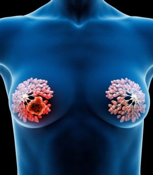 3d,Rendered,Medical,Illustration,Female,Anatomy,-,Breast,Cancer.,Plain