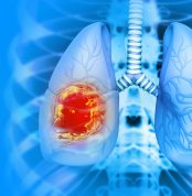 Medical,Illustration,Showing,Lung,Cancer,Or,Bronchial,Carcinoma.,3d,Illustration