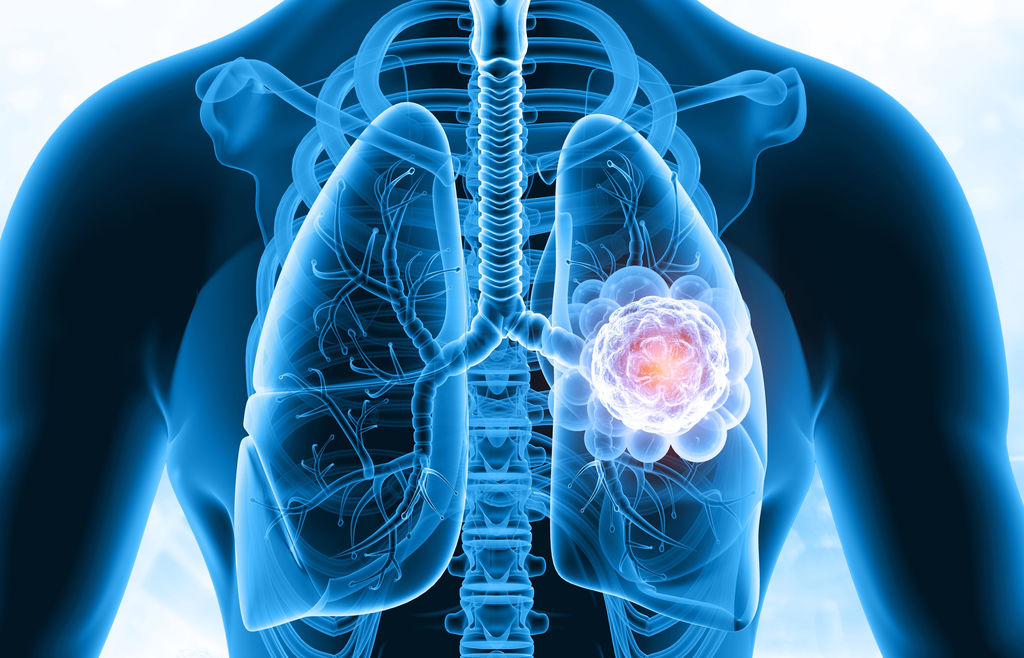 Lungs,Cancer,,Lungs,Infection.,3d,Illustration