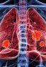 lung tumors